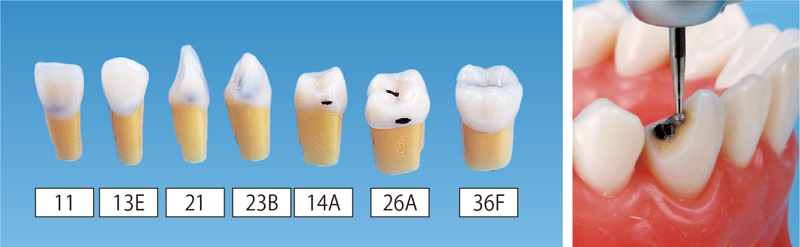カリエス2層模型歯 [A26ANシリーズ]｜株式会社ニッシン｜歯科模型