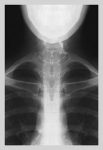 Infant Chest
