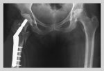 Femur Repair