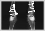 Fixed Tibia
