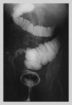 Intestine Barium